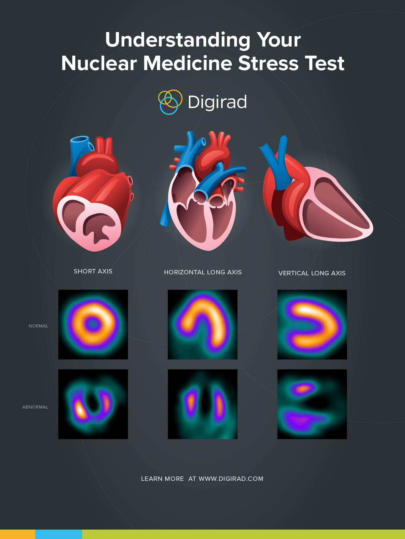 what is a positive nuclear stress test